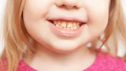 Descubre por qué cambian de color los dientes de los niños – Adeslas Salud y Bienestar 