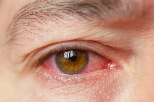 Ulls vermells? Pot ser que tinguis conjuntivitis – Adeslas Salud y Bienestar