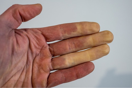 Síndrome de Raynaud: què és i per què es produeix  – Adeslas Salud y Bienestar