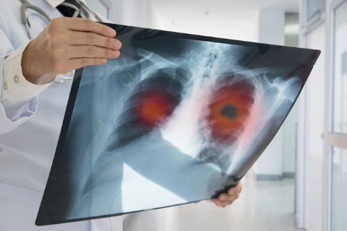 Descobreix per què es produeix i com es pot prevenir el càncer de pulmó - Adeslas Salut i Benestar