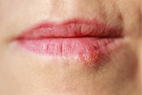 Herpes: ¿qué es y por qué se produce? – Adeslas Salud y Bienestar