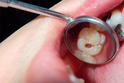 Aprèn a prevenir la càries dental amb aquests consells – Adeslas Salut i Benestar