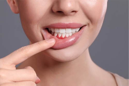 Descobreix què és i per què es produeix la periodontitis – Adeslas Salut i Benestar