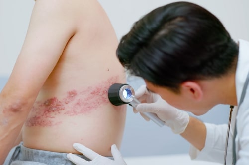 Herpes zóster  Adeslas Salud y Bienestar