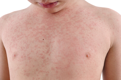 Descubre cómo identificar la urticaria en niños – Adeslas Salud y Bienestar