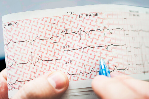 Arritmia cardiaca: ¿en qué consiste?  Adeslas Salud y Bienestar