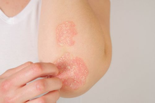 Psoriasi: característiques i recomanacions per manejar-la - Adeslas Salud y Bienestar