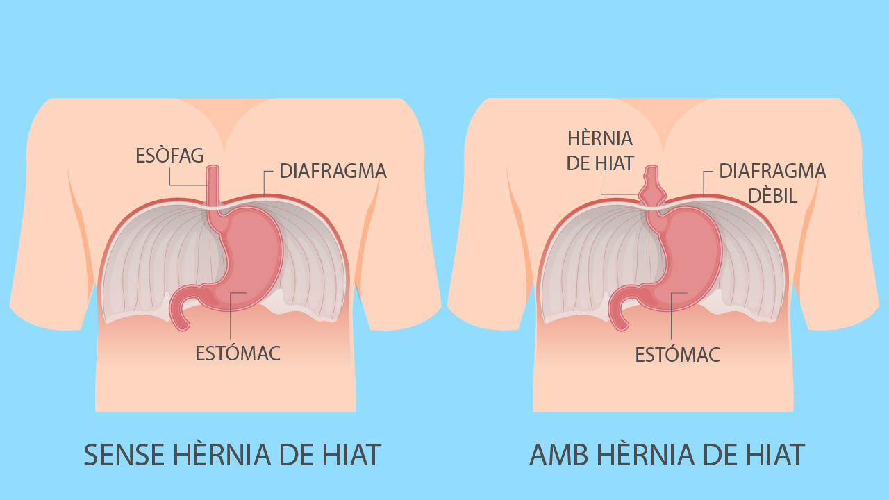 Hèrnia de hiat: què és i com se’n poden alleujar els símptomes? - Adeslas Salud y Bienestar
