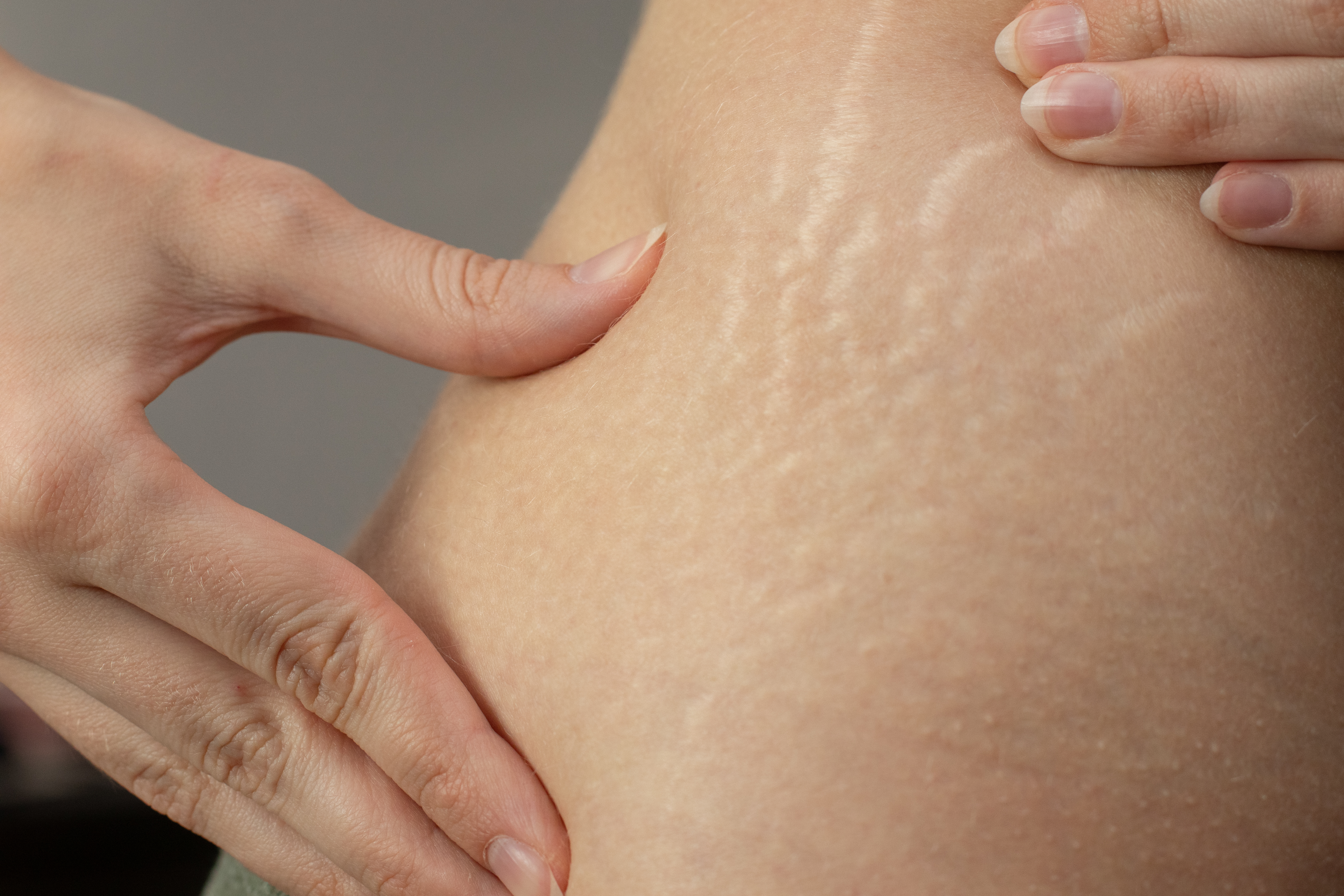 Estries: per què apareixen i quins tractaments hi ha? - Adeslas Salut i Benestar Estries: per què apareixen i quins tractaments hi ha? - Adeslas Salut i Benestar