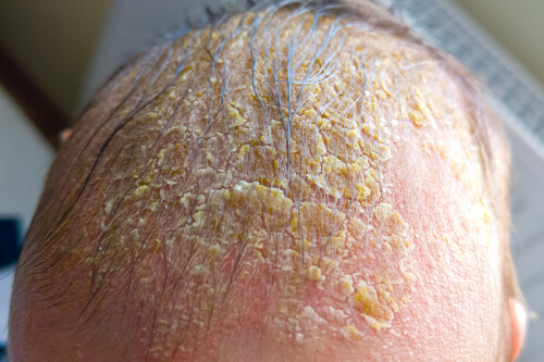 Dermatitis seborreica i crosta làctia - Adeslas Salut i Benestar