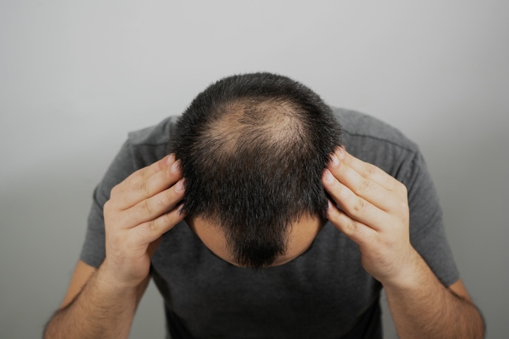Alopècia: causes i tractaments principals - Adeslas Salud y Bienestar