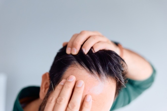 alopecia