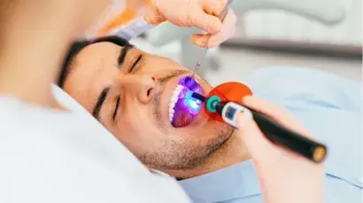 Descubre qué son los selladores dentales y cuándo deben ser aplicados - Adeslas Salud y Bienestar