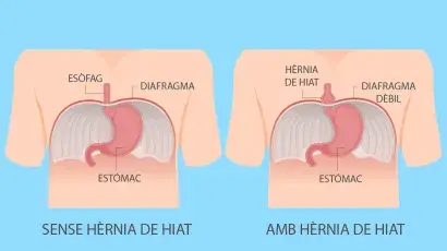 Hèrnia de hiat: què és i com se’n poden alleujar els símptomes? - Adeslas Salud y Bienestar