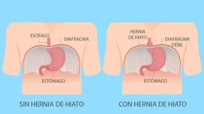 Hernia de hiato: ¿qué es y cómo aliviar los síntomas? - Adeslas Salud y Bienestar 