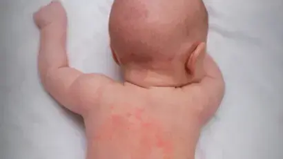 Sarpullido por calor, sudamina o miliaria - Adeslas Salud y Bienestar