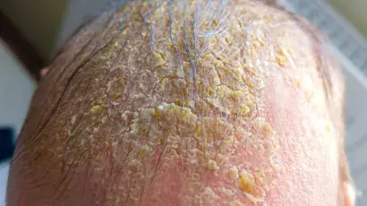 Dermatitis seborreica y costra láctea - Adeslas Salud y Bienestar