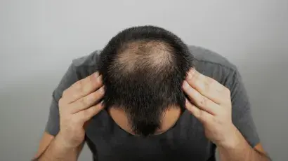 Alopecia: principales causas y tratamientos - Adeslas Salud y Bienestar 
