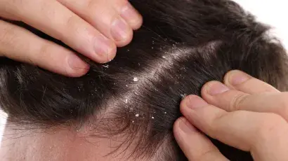 Caspa: causas, tratamientos y cuidados - Adeslas Salud y Bienestar 