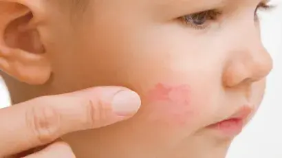 Manchas en la piel del niño: cuándo consultar - Adeslas