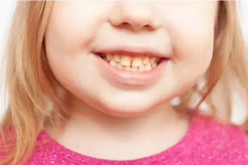 Per què canvia el color de les dents del meu fill?