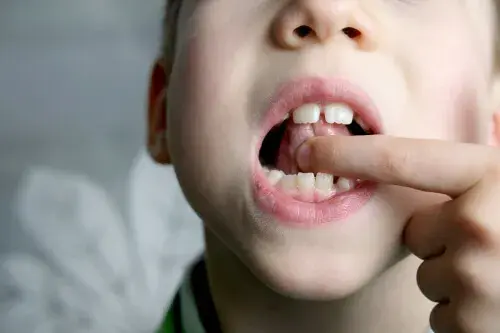 Frenillo y anquiloglosia: ¿Hay que operar siempre?