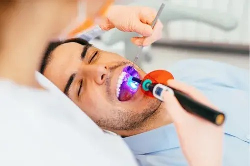¿Qué son y para qué sirven los selladores dentales?