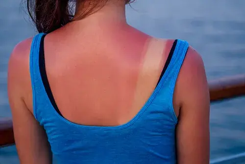 Cremades solars: com s’han de prevenir i abordar