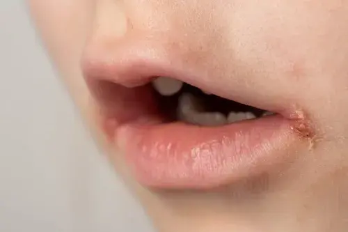 Manejando el impétigo en niños: consejos y tratamientos