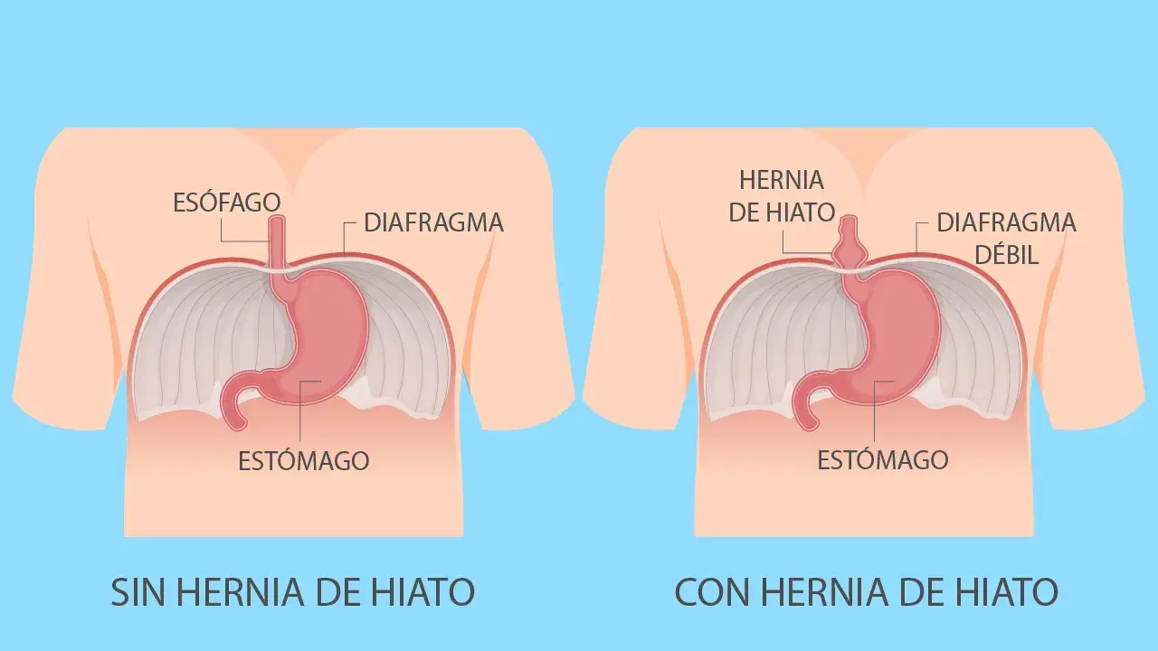 Hernia de hiato: ¿qué es y cómo aliviar los síntomas?