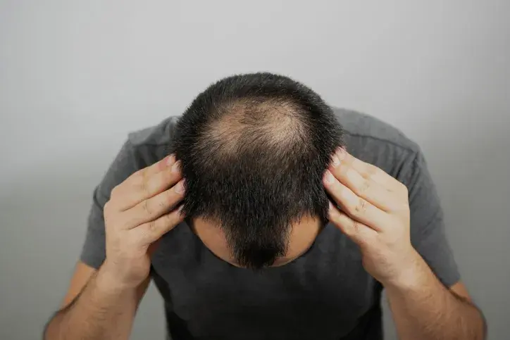 Alopècia: causes i tractaments principals