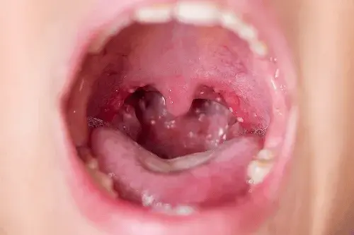 Herpangina: què és i per què no necessita antibiòtic