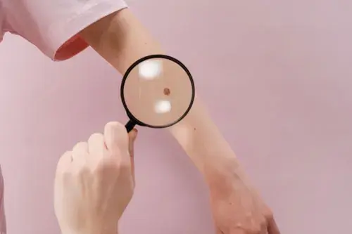 23 de maig: Dia Mundial del Melanoma. Claus de prevenció i detecció